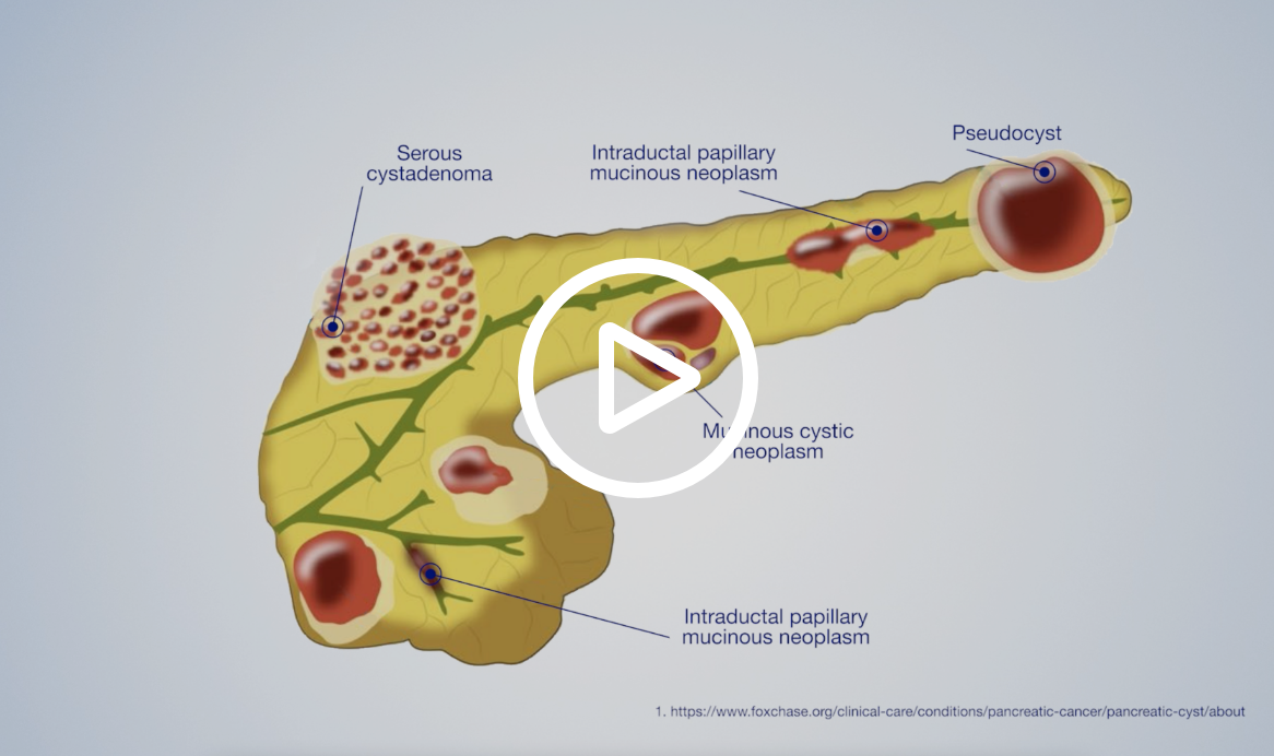 Play EUS Pancreatic Cancer SMC Video